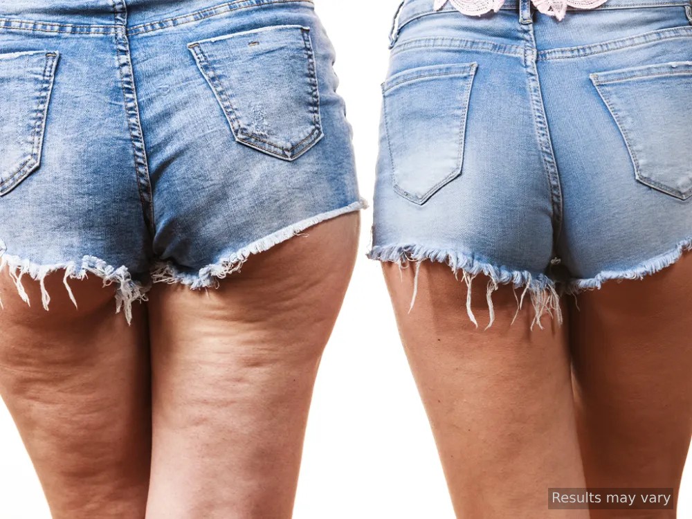 Akusoli Cellulite BA blue C Orb EN
